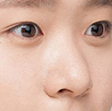 假体隆鼻前后对比照