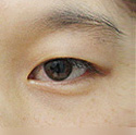 <b>单眼皮整形前后对比照</b>