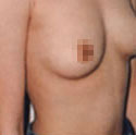 乳房整形前后对比照
