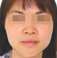 <b>激光嫩肤前后对比照</b>