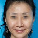 <b>40+辣妈的激光除皱日记</b>