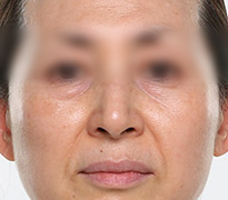 傲洛斯除皱前后对比照