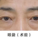 去除眼袋前后对比照