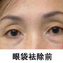 眼袋祛除前后对比照