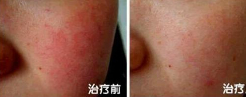 面部红血丝怎么改善好