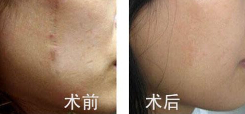 怎么去脸上的疤痕