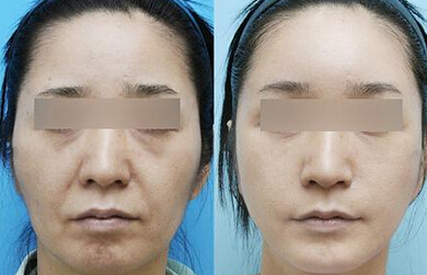 拉皮除皱是安全的除皱方法吗