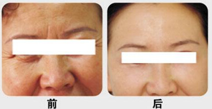小切口除皱效果到底怎样