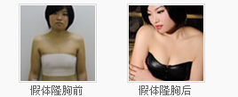 假体隆胸前后对比图