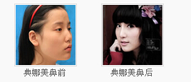 典娜美鼻前后对比图