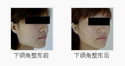 下颌角整形前后对比图