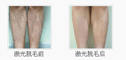 激光脱毛前后对比照