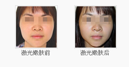 激光嫩肤前后对比照
