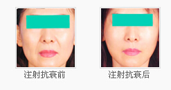 注射抗衰前后对比照