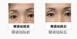 眼袋祛除前后对比照