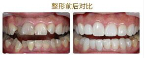 烤瓷牙失败怎么办