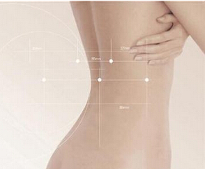 吸脂减肥真的有效吗