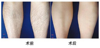 小腿怎样脱毛2