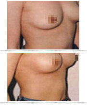 乳房整形前后对比照
