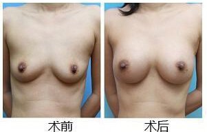 自体脂肪丰胸手术注意事项