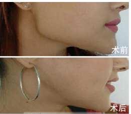 下颌角整形术怎么样