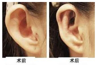 招风耳整形有什么方法