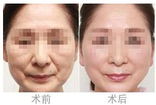 微创面部提升术