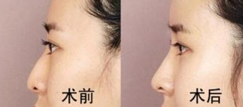 鼻头整形