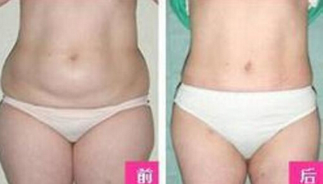 美弧小腿紧致术