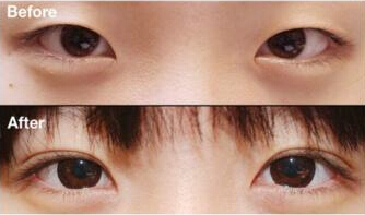 精细无痕重睑术