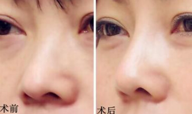 整体式鼻塑形