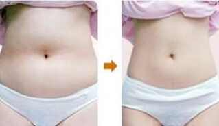 腰腹部吸脂