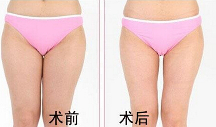小腿抽脂的价格是多少