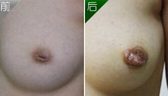 乳头内陷怎样整形