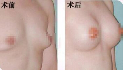 乳房下垂怎么矫正