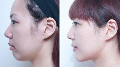 丰下巴材料有哪些