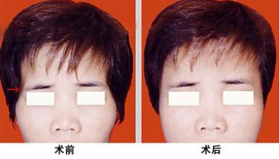 假体填充太阳穴有副作用吗