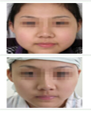 面部吸脂前后对比照