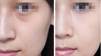 自体脂肪去泪沟效果怎么样