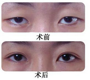 双眼皮手术是如何进行的