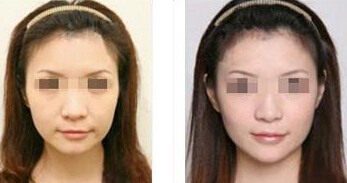 面部除皱