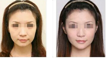 拉皮除皱效果怎么样