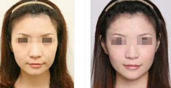拉皮手术适合什么年龄