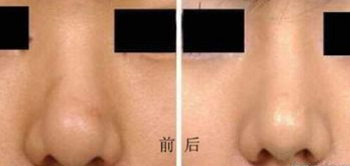 鼻部整形费用要多少