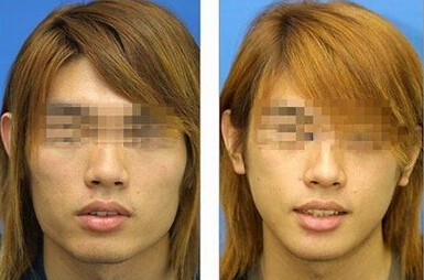 男人如何瘦脸