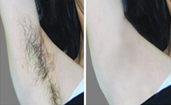 冰点脱毛全身包干多少钱