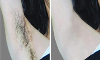 腋毛浓密咋办