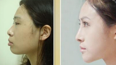 硅胶假体隆鼻管多久