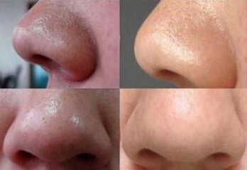 鼻子上有黑头怎么办