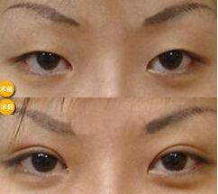 成都做双眼皮大概多少钱